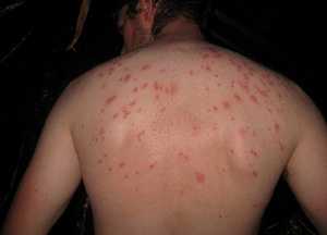 Аллергия на укусы клопов